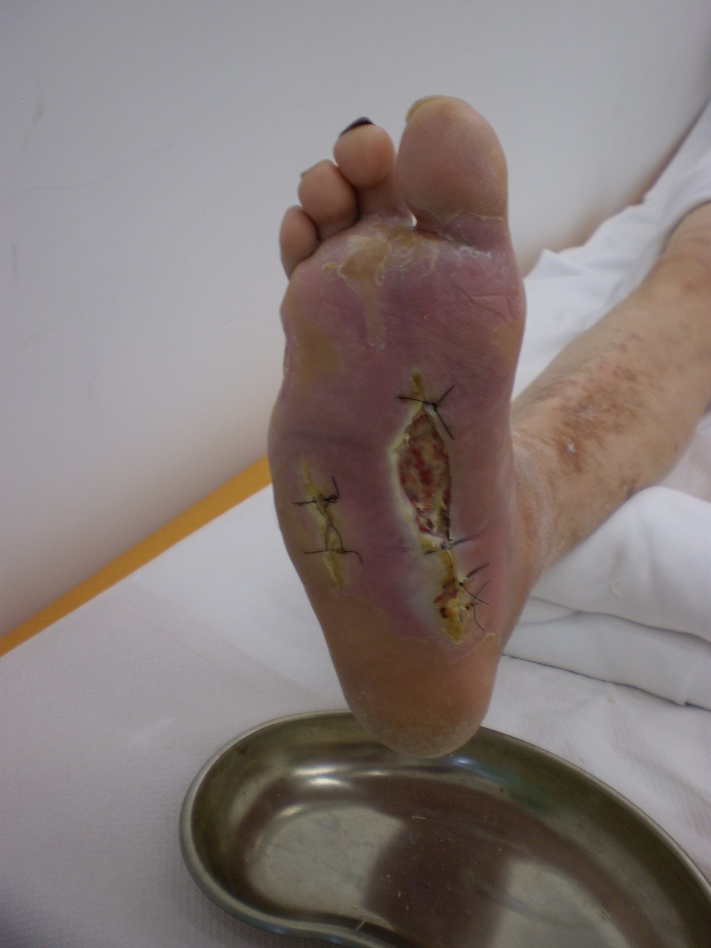 Figure 14.3 — Diabetic foot syndrome (clinical photograph): representative example of an advanced (Wagner Grade 4) diabetic foot with localized forefoot tissue loss, illustrating the endpoint of progressive ulceration along the Wagner spectrum from Grade 0 (intact at-risk foot with deformity and callus) through Grade 1 (superficial ulcer), Grade 2 (deep ulcer probing to tendon or bone), Grade 3 (osteomyelitis), Grade 4 (localized gangrene), to Grade 5 (extensive gangrene requiring major amputation).