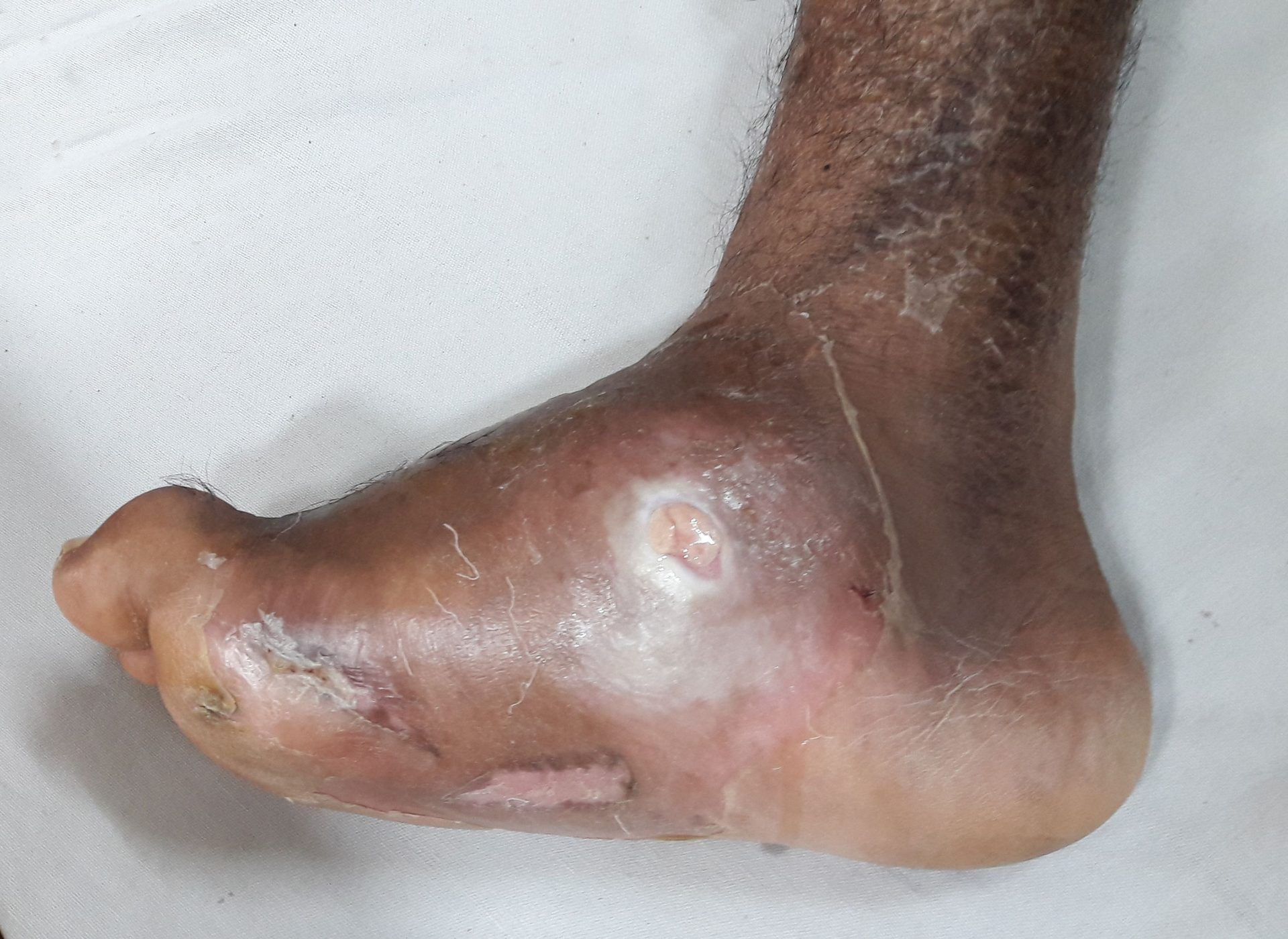 Figure 14.4 — Diabetic Charcot foot deformity with ulcerated abscess: clinical photograph showing the chronic midfoot collapse and rocker-bottom architecture characteristic of late-stage Charcot neuroarthropathy. Diagnostic threshold for active disease is a temperature differential ≥ 2°C versus the contralateral foot; resolution is defined as < 2°C.