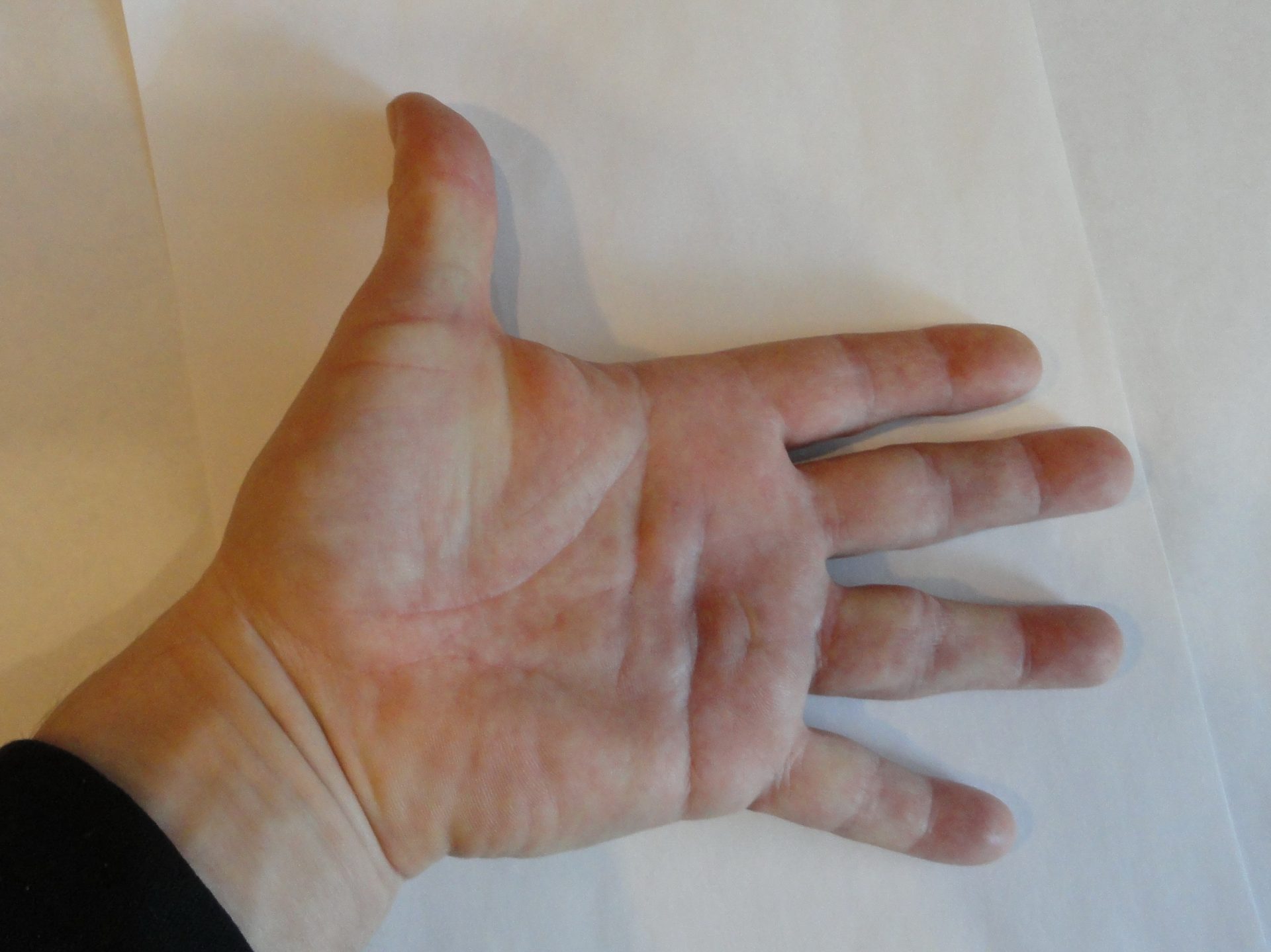 Figure 7.2 — Dupuytren Contracture Clinical Presentation