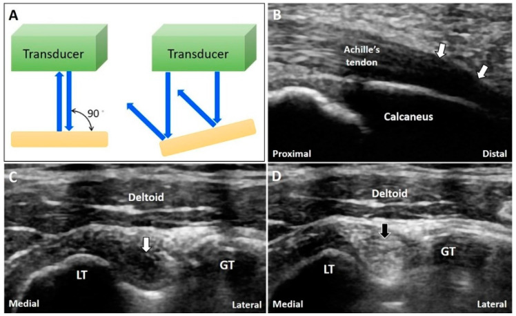 Figure 25.8 — Anisotropy Artifact in Tendon Ultrasound (Achilles Insertion and Biceps Tendon)