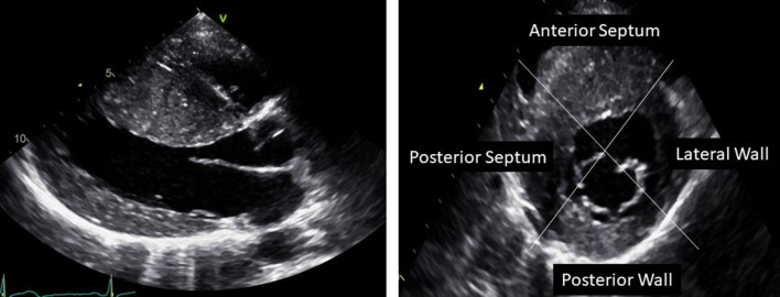Figure 30.6 — HCM Echocardiogram: Parasternal Long- and Short-Axis Views Showing Asymmetric Septal Hypertrophy (MWT 30 mm)