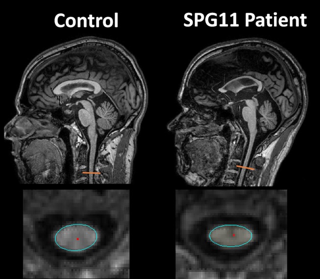 Figure 6.6 — Spinal Cord MRI: HSP Cord Atrophy (SPG11). Sagittal T1 (top) and axial T1 (bottom) MRI comparing a healthy control (left) with a patient with hereditary spastic paraplegia type 11 (SPG11, right). The patient demonstrates cervical spinal cord atrophy and antero-posterior flattening (orange marker, sagittal; cyan outline, axial cross-section), without focal T2-hyperintense plaques or gadolinium enhancement — the imaging signature that distinguishes length-dependent corticospinal degeneration in HSP from MS, NMOSD, or transverse myelitis. Note absence of focal demyelinating lesions and the symmetric reduction in cord cross-sectional area.