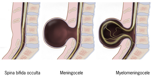 Figure 3.1 — Spectrum of spina bifida: occulta (vertebral arch defect, intact skin, no MSAFP elevation), meningocele (sac with meninges only, MSAFP elevated, better prognosis), and myelomeningocele (sac with meninges and exposed neural tissue, MSAFP elevated, the most clinically significant NTD). Lipomyelomeningocele (closed dysraphism with lipoma adherent to cord) is a related closed form not pictured.