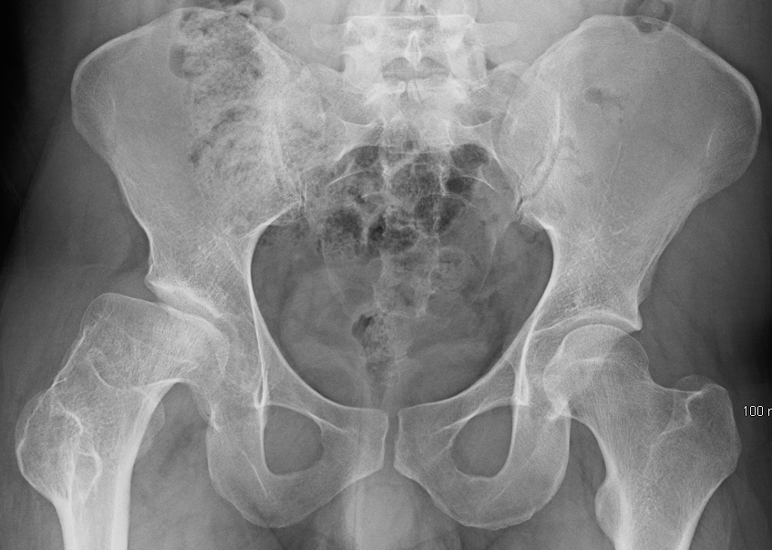 Figure 9.2 — Legg-Calvé-Perthes disease: AP pelvis radiograph showing femoral head AVN with fragmentation and lateral pillar collapse.