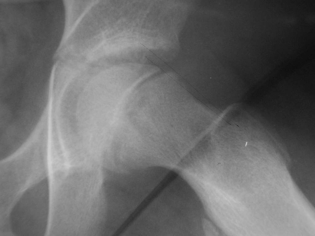 Figure 9.3 — Slipped capital femoral epiphysis (SCFE) frog-leg lateral radiograph with Klein line drawn along the superior femoral neck failing to intersect the femoral head (“ice cream falling off cone”).