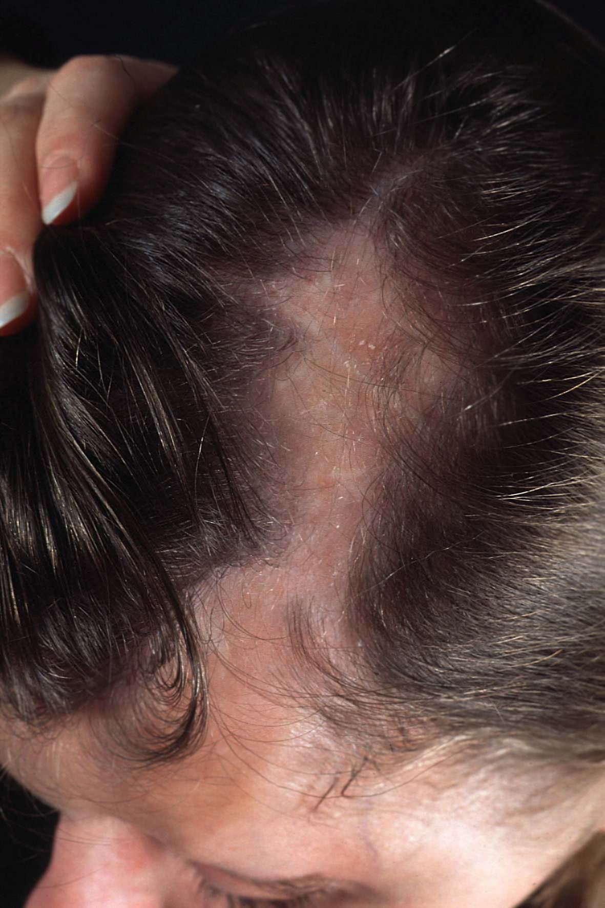 Figure — En Coup de Sabre: Linear Morphea of the Forehead and Scalp