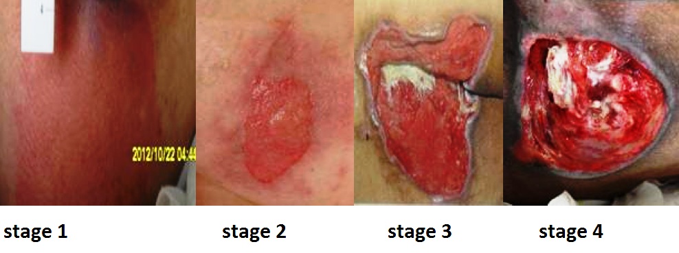Figure 12.1a — Tissue-layer schematic of pressure injury stages 1–4 (epidermis, dermis, subcutaneous tissue, muscle, bone)
